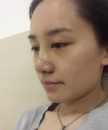 華西醫(yī)院卿勇醫(yī)生隆鼻案例分享，術(shù)后果真實(shí)圖流出