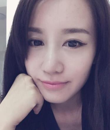 華西醫(yī)院卿勇醫(yī)生隆鼻案例分享，術(shù)后果真實(shí)圖流出