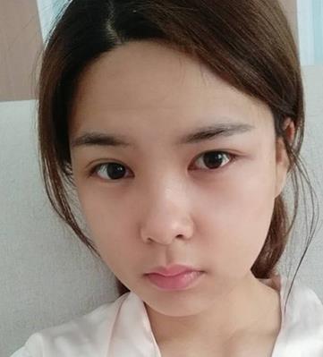 【張笑天】磨骨怎么樣？醫(yī)生介紹及真人案例分享