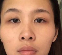 成都玉之光整形醫(yī)院豐太陽穴真人術(shù)后恢復實述