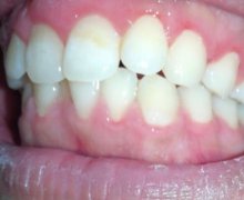 浙江口腔醫(yī)院整牙怎么樣？果好嗎？看案例恢復分享