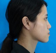 山西醫(yī)科大學(xué)醫(yī)院整形美容科自體脂肪面部填充真實(shí)果照公布