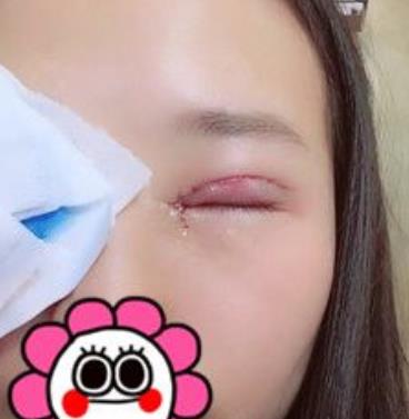 沈陽(yáng)杏林張瑩瑩雙眼皮案例？看醫(yī)生簡(jiǎn)介和技術(shù)如何