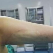 南京鼓樓醫(yī)院美容科價目表（價格），手臂吸脂案例圖鑒！