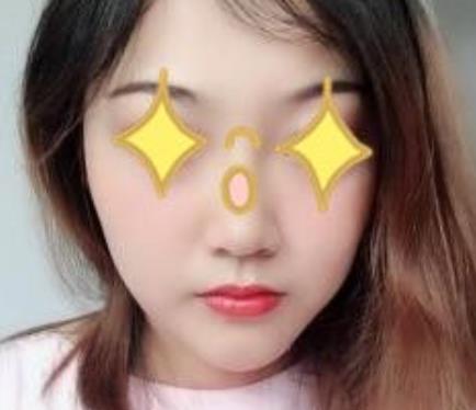 上海伊美爾港華醫(yī)院磨骨真人案例果圖流出：對比挺明X