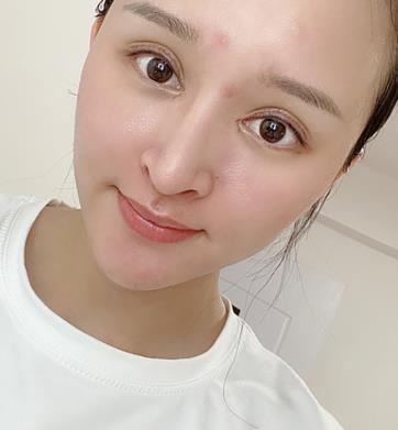 長(zhǎng)春趙廣文院長(zhǎng)眼部手術(shù)術(shù)后半年果分享：眼型較為適合我