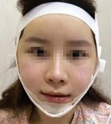 哈醫(yī)大一院整形美容科顴骨內(nèi)推案例圖分享&小姐姐自述喔