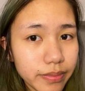 西京醫(yī)院隆鼻怎么樣？術后果及整形科價格表一覽