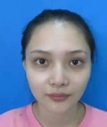 深圳北大醫(yī)院整形外科去眼袋怎么樣？心得體會：年輕沒煩惱！