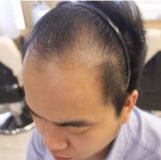 南方醫(yī)院植發(fā)沒問題嗎？果怎么樣？真人案例|植發(fā)拯救發(fā)際線