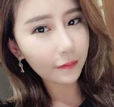 北京藝美王東醫(yī)生脂肪填充案例公開，術(shù)后太陽(yáng)穴飽滿自然