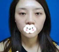 北京東方和諧馮斌脂肪面部填充案例：飽滿度還不錯！