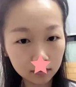 成都華西醫(yī)院整形科雙眼皮怎么樣？術(shù)后一個(gè)月果展示