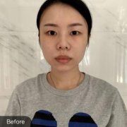 湖州曙光李祿增雙眼皮技術(shù)怎么樣？兩個月后還是挺自然的