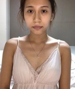 重慶一附院整形科真人隆胸案例，自然恢復(fù)過(guò)程圖分享