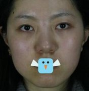 臺(tái)州藝星耳軟骨隆鼻果怎么樣？請(qǐng)參考李星星真人隆鼻案例