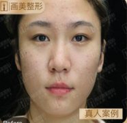 【羅金剛】西安畫美全切雙眼皮術(shù)前術(shù)后照片|對比真實(shí)果