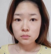 上海華美李志海磨骨怎么樣？案例分享：從女漢子到少女的蛻變！