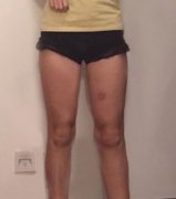 去成都華西醫(yī)院整形科做了大腿吸脂手術，夏天終于敢露腿了！