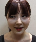 邯鄲市第四醫(yī)院整形科自體脂肪填充面部日記展示，飽滿自然敲可愛