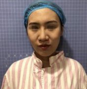 長沙愛**吳蒙隆鼻案例反饋：三個月果圖安排上！