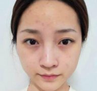 上海九院李青峰做鼻子怎么樣預約？案例手術(shù)風格盡顯！