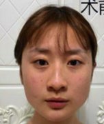 上海仁愛醫(yī)院整形科磨骨怎么樣？下頜角案例全新來襲，可參考！