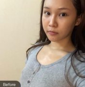 濟(jì)寧名美整形美容醫(yī)院自體脂肪豐胸術(shù)后一個(gè)月，胸部真的變得很大哦
