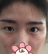 廣州南方醫(yī)院整形科馮傳波醫(yī)生雙眼皮案例來了，真實果打卡！