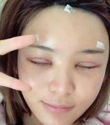 北京玉之光王明利做自體脂肪填充怎么樣?面部填充案例分享【多圖】！