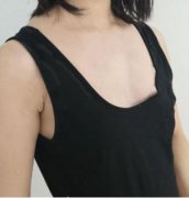 北京大學(xué)第三醫(yī)院整形科趙振民隆胸怎么樣？案例果對比實拍圖