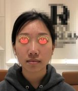 浙江大學醫(yī)學院附屬第一醫(yī)院整形科范希玲鼻整形真實案例+恢復圖分享