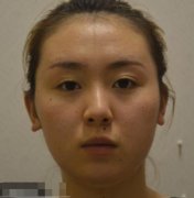 蘭州時(shí)光激光美容祛斑怎么樣？手術(shù)果（費(fèi)用）了解一下！