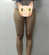 鄭大二附院整形科劉月麗抽脂怎么樣？大腿抽脂案例來查看！