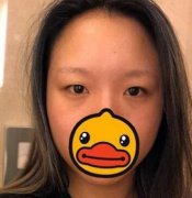 成都西區(qū)醫(yī)院整形鄧東偉雙眼皮怎么樣？術(shù)后一個月果圖可見！