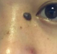 火箭軍總醫(yī)院整形外科激光點(diǎn)痣怎么樣？手術(shù)果一覽