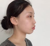 上海九院整形科做熱瑪吉怎么樣?術后案例果對比圖分享