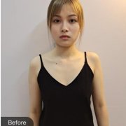 西安高一生隆胸怎么樣？看張林宏做的手術(shù)案例參考果如何