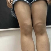 八大處王春虎怎么樣？個人簡介和吸脂手術(shù)前后全過程圖片分享