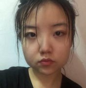 下頜角整形案例及價(jià)格表明細(xì)一覽！