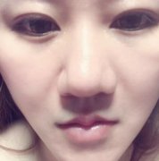 濟南華美整形醫(yī)院脂肪填充面部果圖一覽，經驗反饋