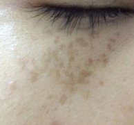 濟(jì)南華夏醫(yī)院激光美容科祛斑怎么樣？術(shù)后果圖分享