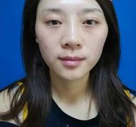 淮安市第一人民醫(yī)院整形美容科面部脂肪填充真人案例~含果對比圖