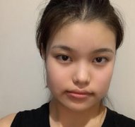 北京圣嘉新張笑天醫(yī)生下頜角磨骨手術(shù)反饋：術(shù)前術(shù)后顏值差別太大！