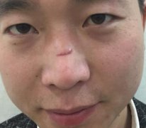 宜昌市中醫(yī)醫(yī)院整形科去疤痕怎么樣？案例果分享