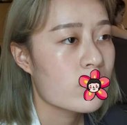 上海時(shí)光何晉龍醫(yī)生下頜角磨骨真人案例分享！