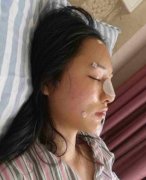 北京柏麗李勁良醫(yī)生隆鼻怎么樣？看案例果及價(jià)格明細(xì)表