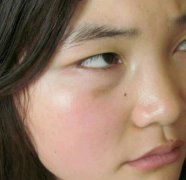 新沂市人民醫(yī)院整形美容科去疤痕好嗎？恢復(fù)果圖一覽