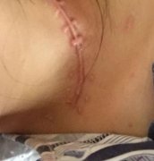 成都軍建整形醫(yī)院去疤痕多少錢？果好嗎？