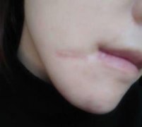 寶雞市中心醫(yī)院美容科激光去疤怎么樣？價格費用參考